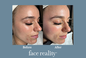 90-Day Acne Boot Camp before and after